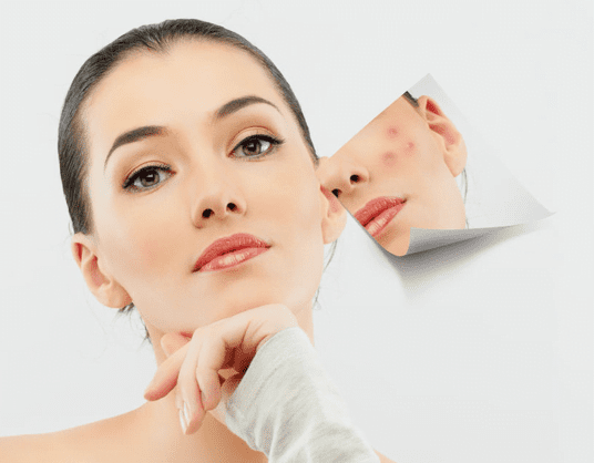 5 cách chữa vết thâm sau mụn hiệu quả cho làn da sáng mịn