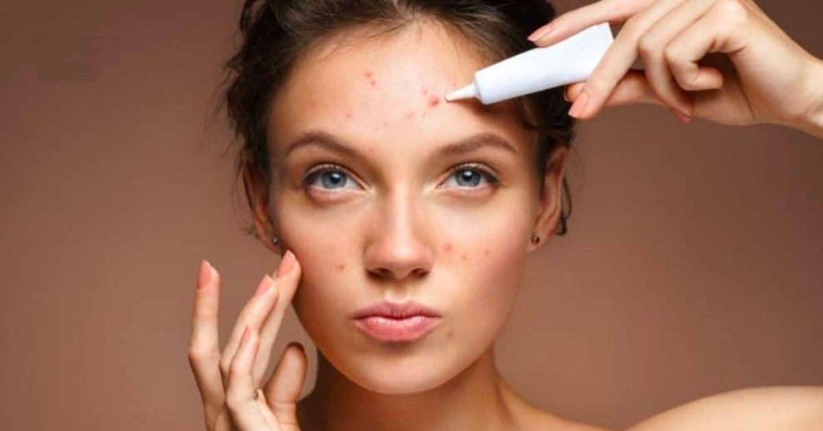 10 cách trị mụn ẩn đơn giản nhưng đem lại hiệu quả bất ngờ cho làn da của bạn